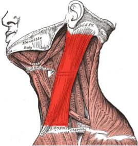 Torticollis
