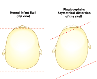 Torticollis