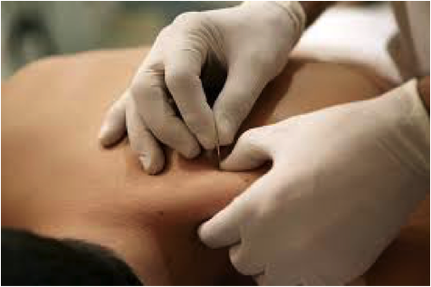 Dry needling specialty at Aquacare