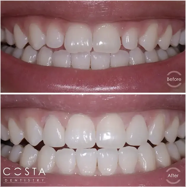 Before and after photo showcasing significant veneer results, highlighting improved brightness and overall appearance.