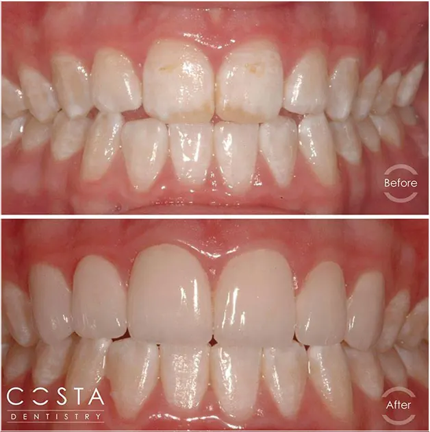 Before and after photo showcasing significant veneer results, highlighting improved brightness and overall appearance.