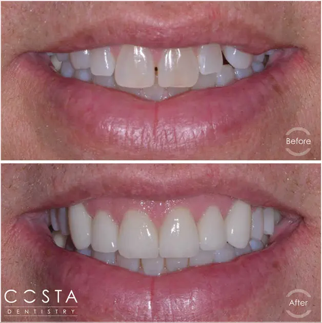 Before and after photo showcasing significant veneer results, highlighting improved brightness and overall appearance.