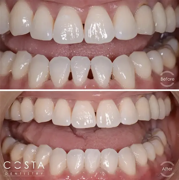 Before and after photo showcasing significant veneer results, highlighting improved brightness and overall appearance.