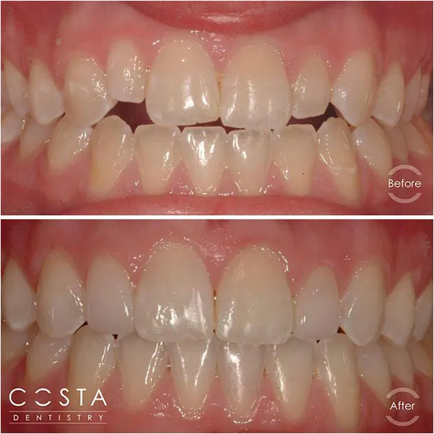 Before and after photo showcasing significant veneer results, highlighting improved brightness and overall appearance.