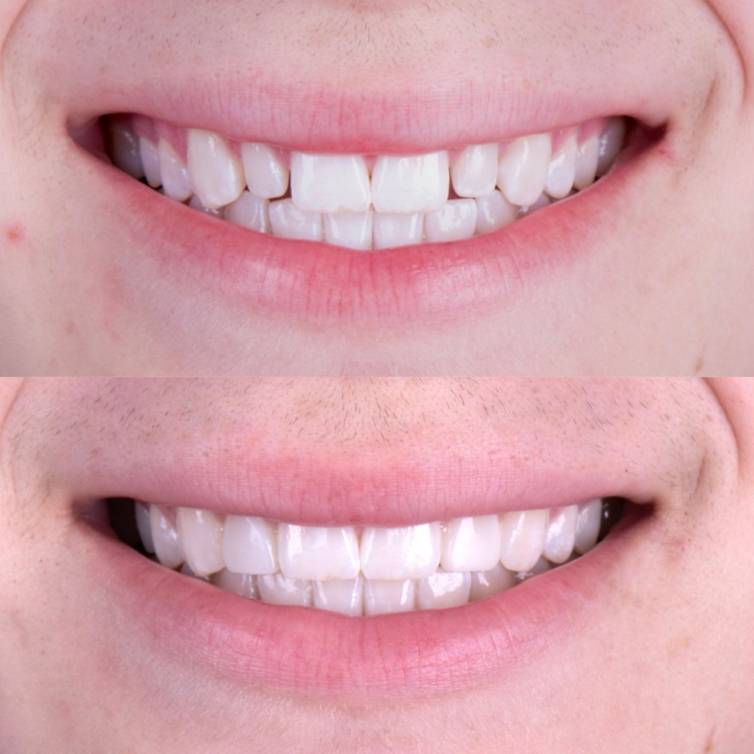 A woman's smile before and after teeth, showcasing a significant improvement in brightness and confidence.