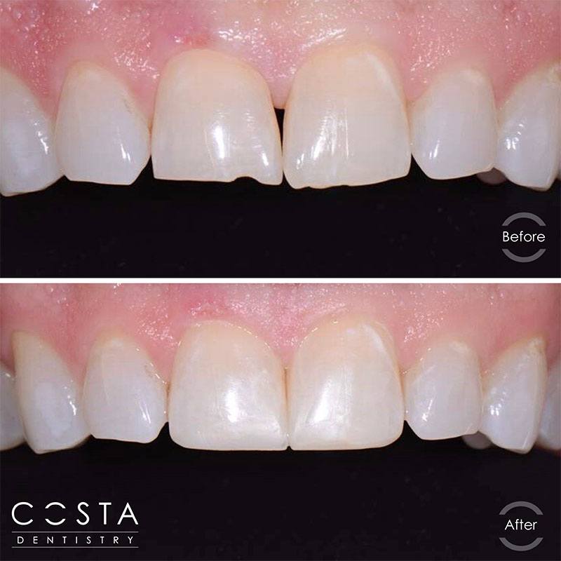 A woman's smile before and after teeth, showcasing a significant improvement in brightness and confidence.