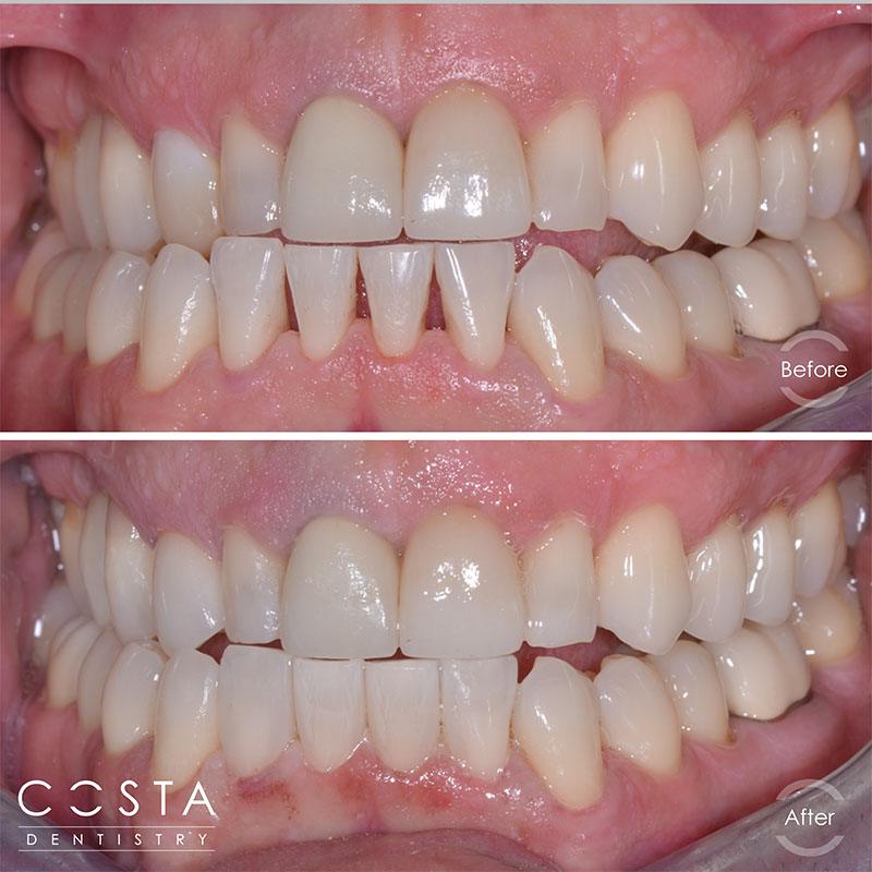 A woman's smile before and after teeth, showcasing a significant improvement in brightness and confidence.