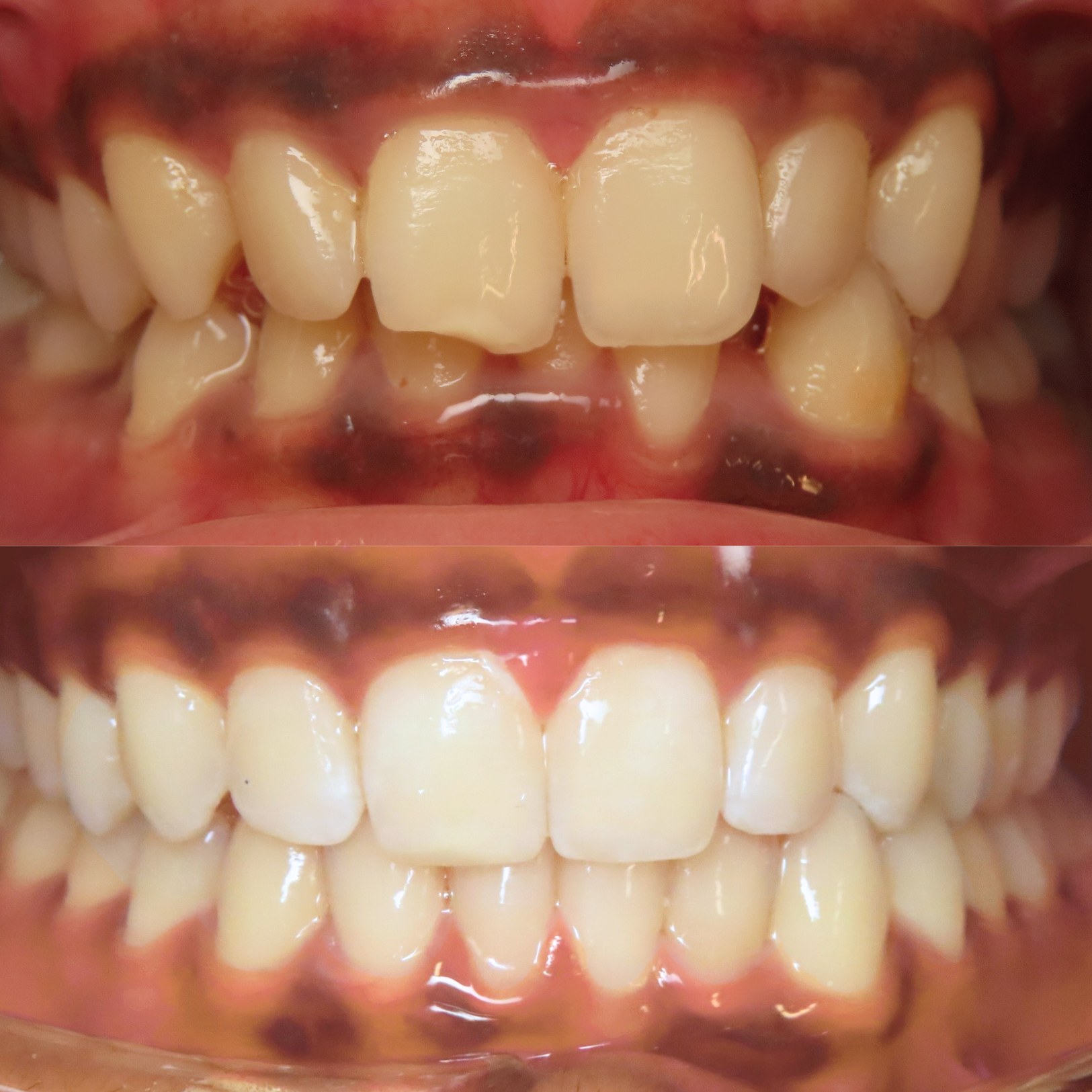 A person's smile before and after teeth, showcasing a significant improvement in brightness and confidence.