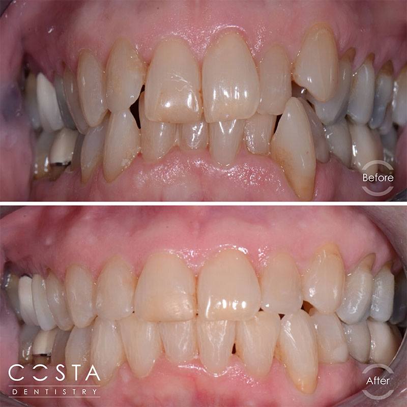 A woman's smile before and after teeth, showcasing a significant improvement in brightness and confidence.