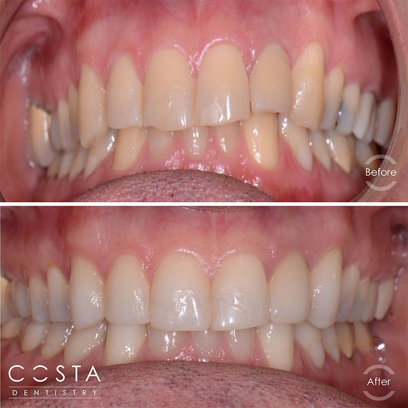Before and after photo showcasing significant veneer results, highlighting improved brightness and overall appearance.