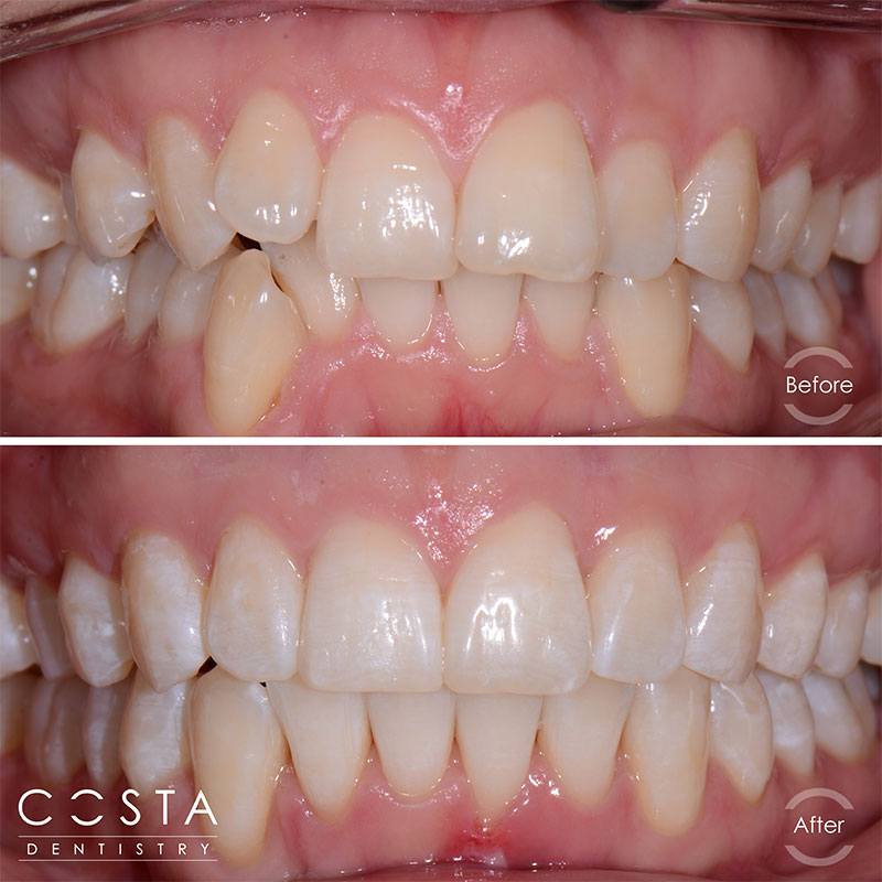 Before and after photo showcasing significant veneer results, highlighting improved brightness and overall appearance.