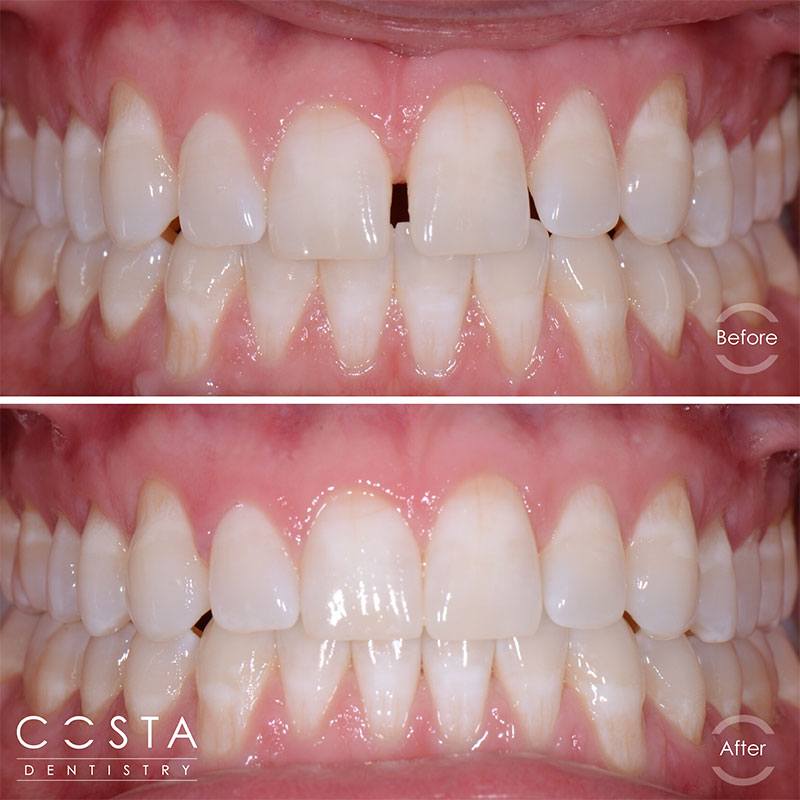 Before and after photo showcasing significant veneer results, highlighting improved brightness and overall appearance.