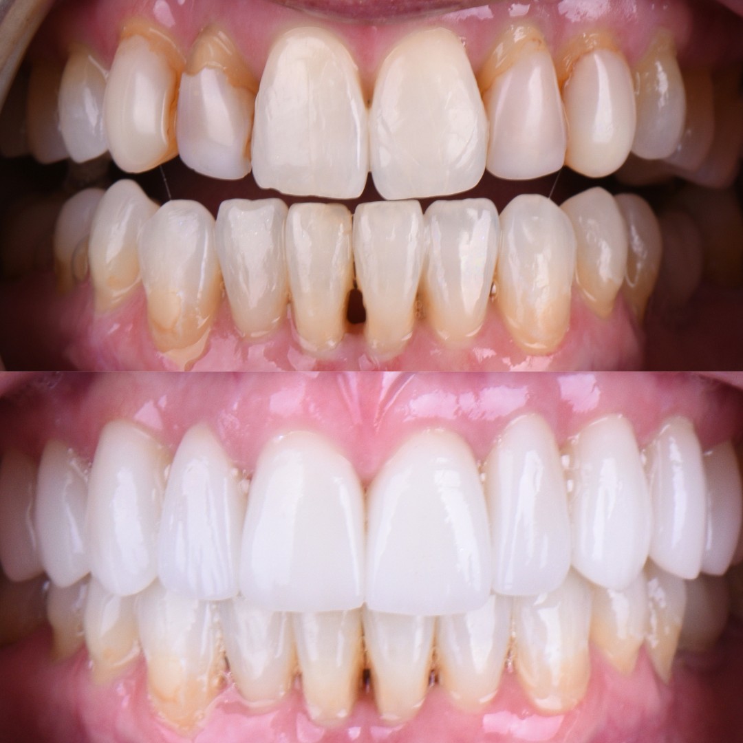 Before and after photo showcasing significant veneer results, highlighting improved brightness and overall appearance.
