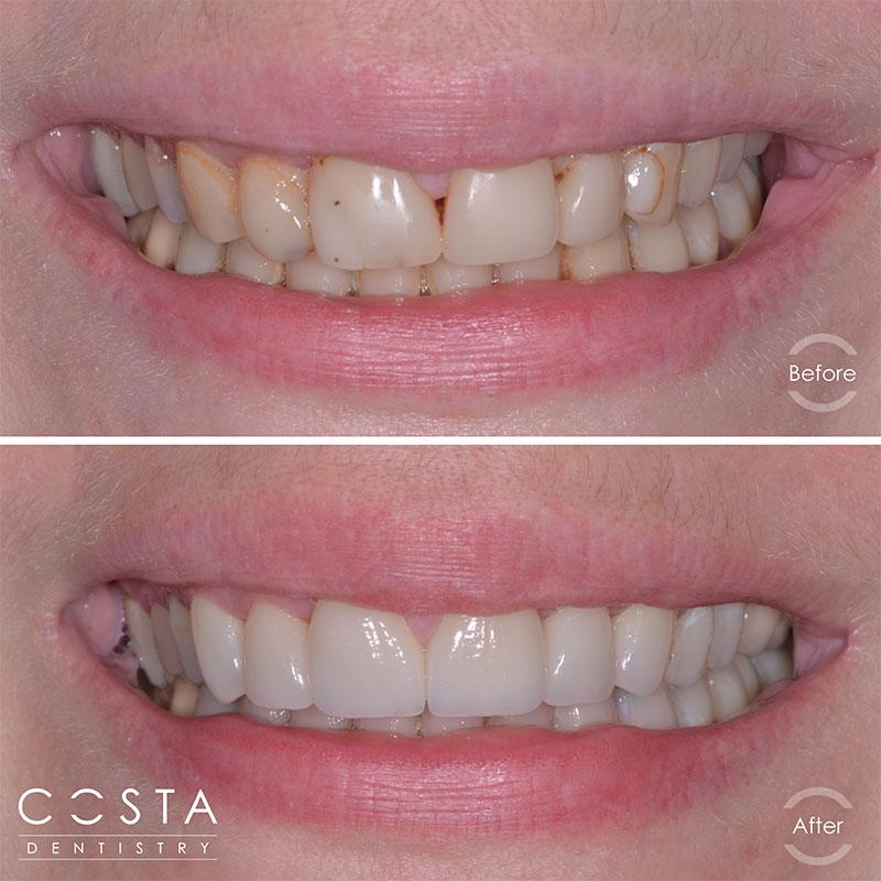 Before and after photo showcasing significant veneer results, highlighting improved brightness and overall appearance.