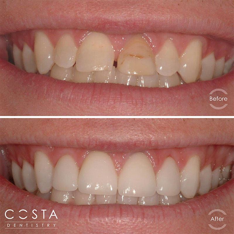 Before and after photo showcasing significant veneer results, highlighting improved brightness and overall appearance.