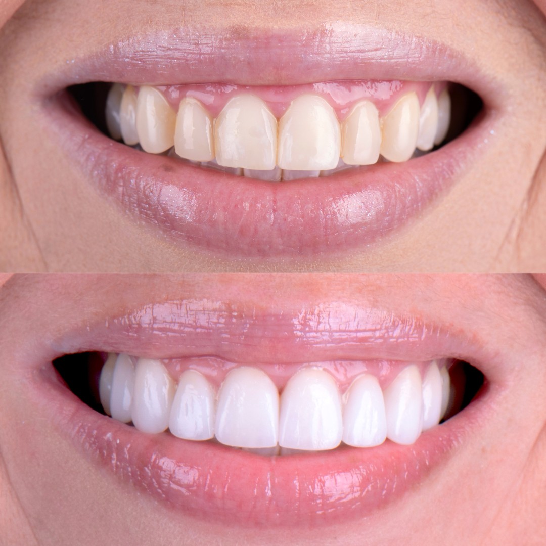 A woman's smile before and after teeth, showcasing a significant improvement in brightness and confidence.