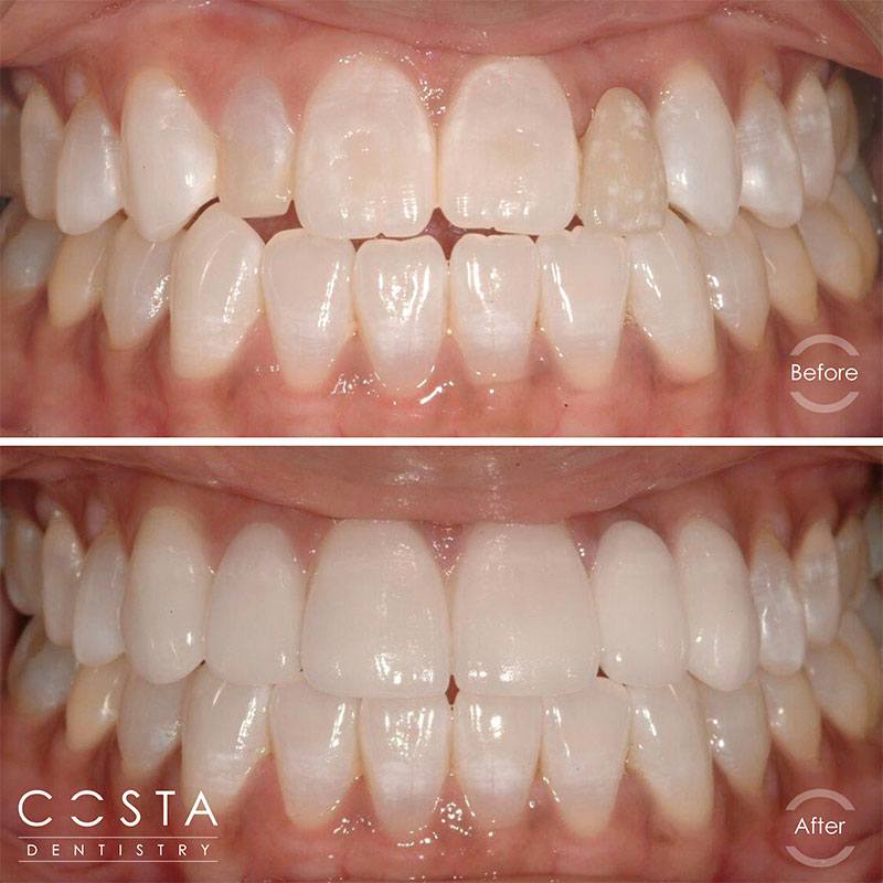 Before and after photo showcasing significant veneer results, highlighting improved brightness