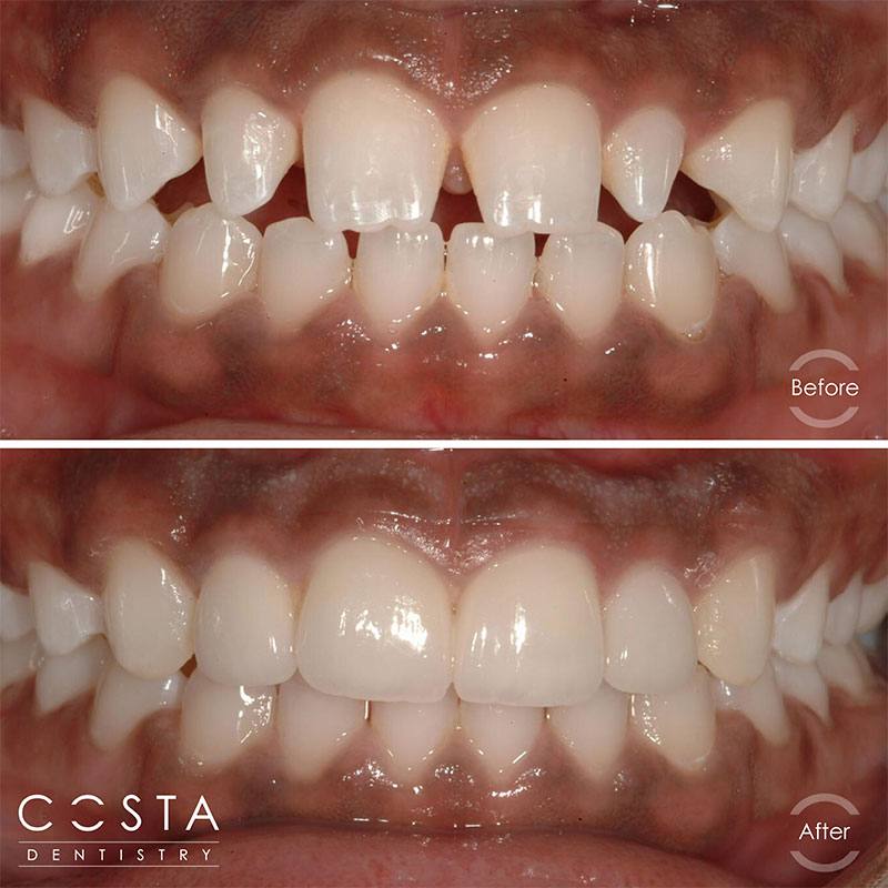 Before and after photo showcasing significant veneer results, highlighting improved brightness and overall appearance.